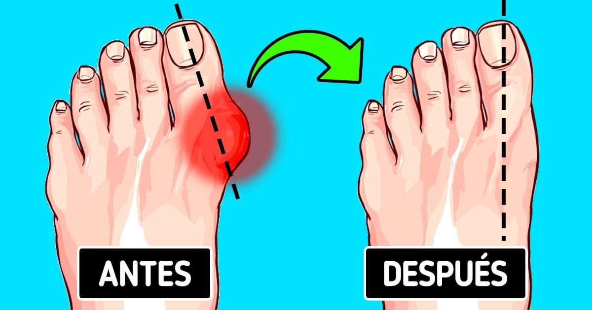 7 Métodos Efectivos para Tratar los Juanetes (Actualización 2025)